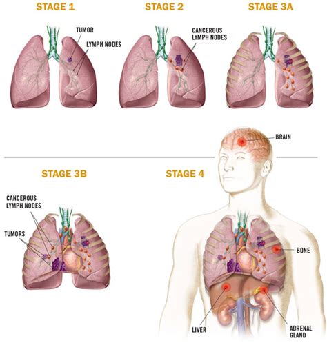 A variety of factors ultimately influence a patient's decision to receive treatment of cancer. Lung Cancer: Symptoms, Causes, Diagnosis & Treatment » How ...