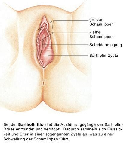 Ursachen gibt es dafür viele. Geschwollene Schamlippe rechts? Was kann ich da machen ...