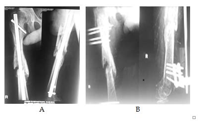 Prophylactic Fixation of Impending Fractures - MedCrave online