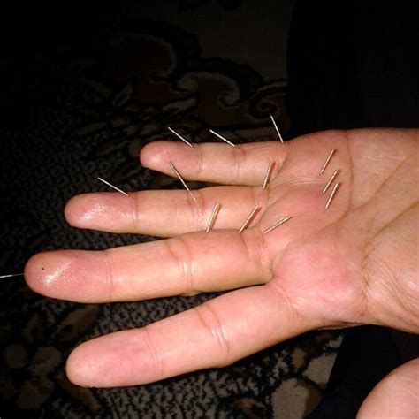 Terdapat beberapa keadaan yang boleh menyebabkan tangan berasa kebas. Akupunktur tangan untuk kebas-kebas badan sebelah kiri. Ba ...