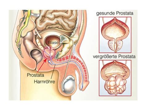 Weshalb ist das thema prostatakrebsvorsorge wichtig? Prostata-Krebs: Mann, pass auf Dich auf! | EAT SMARTER