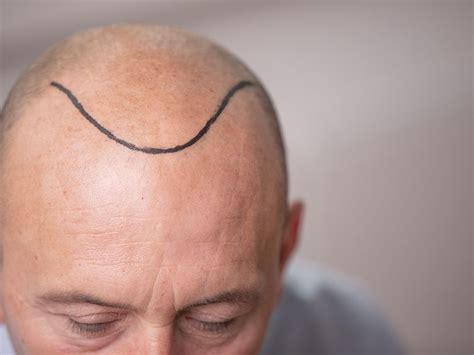 Sammeln der haare aus dem spenderbereich der person. Fallen die eingepflanzten Haare immer nach der ...