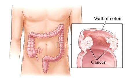 For anyone who has been diagnosed with colon/rectal cancer, what were your symptoms that prompted you to contact your physician? Stage 4 Colon Cancer Life Expectancy « CancerWORLD Cancer ...