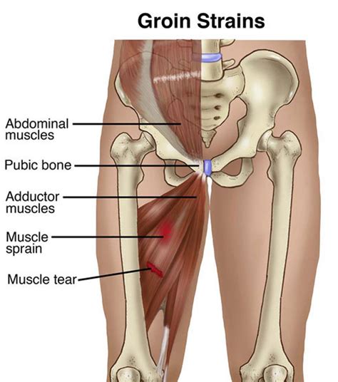 Muscle and tendon anatomy of the hip (adductors, gluteal muscles (or buttocks), hamstring muscles, femoral muscle quadrices). A Groin Pull By Any Other Name — Miami Sports Chiropractic ...