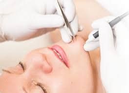 What to keep in mind before receiving treatment. Electrolysis hair removal at The Angel Laser Clinic - The ...