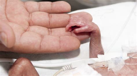 Everyone has different opinions on the best way to do everything when it comes to raising babies; 24 Week Old Baby Survives Abortion | cultureshift