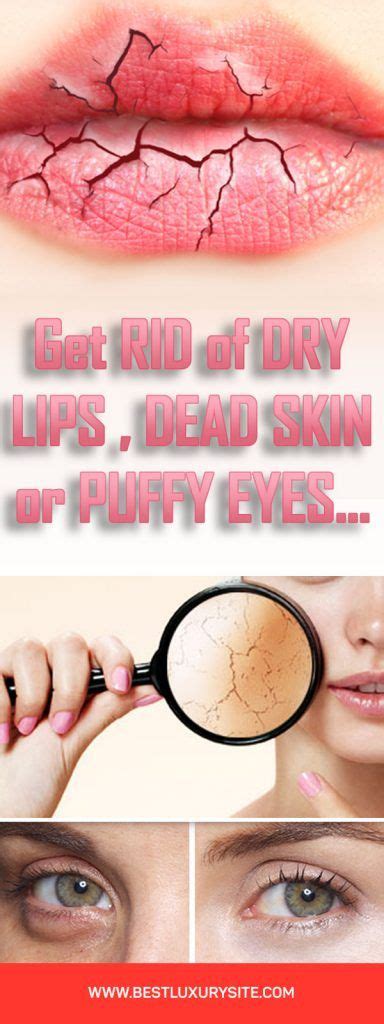 How do you get rid of dead skin on your lips? Get Rid of dry lips dead skin or puffy | Dry lips, Natural ...