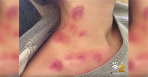 They signal to the world that you have done it in the recent past. Teenagers Dying From Hickeys! Doctors Issue Warnings watch