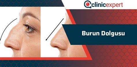 Burunda şekil bozuklukları ve burun estetiği. Burun Dolgusu | ClinicExpert Uluslararası Sağlık Hizmetleri