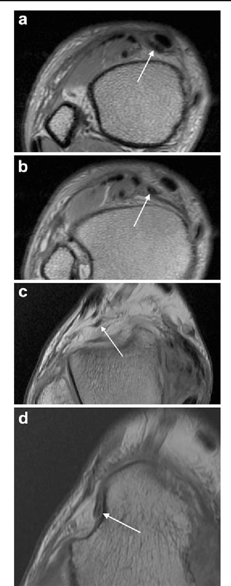 Indications for foot mri scan. MRI of the tibioastragalus anticus of Gruber muscle: a ...