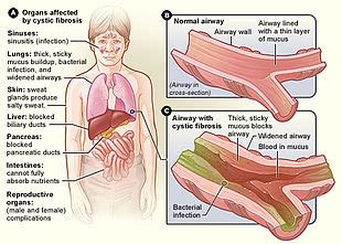 Cystic fibrosis foundation consensus report. Mukoviszidose - Cystic fibrosis - qaz.wiki