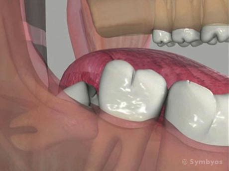 Many patients return to work in a couple of days every patient is unique, but most are able to get back on the job within two or three days of the wisdom teeth removal procedure. Surgical Tooth Extractions - ToothIQ