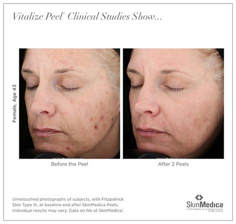 Correction@@ it was the vitalize peel! Before And After Photos for Facial Chemical Peels | Garcia ...