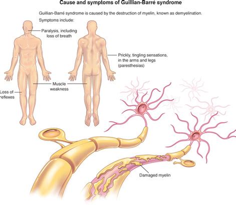 It is characterized by abnormal muscle coordination with poor balance and clumsy walking, weakness or paralysis of the eye muscles, and absence of the tendon reflexes. Guillain-Barré Syndrome - CprepLab: Anatomy & Physiology