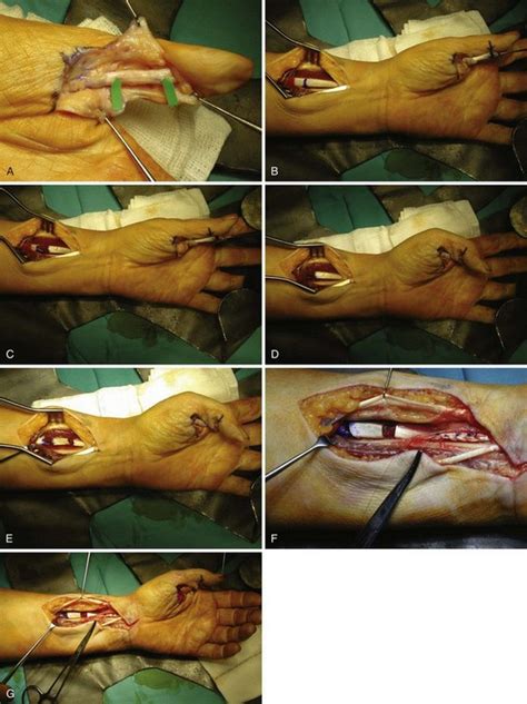 Start studying forearm flexor muscles. Secondary Reconstruction of the Flexor Pollicis Longus Tendon | Plastic Surgery Key