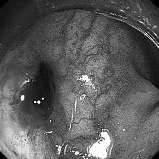Other anastomotic congurations after resection in crohns disease. (PDF) Successful endoscopic hemostasis for bleeding from ...