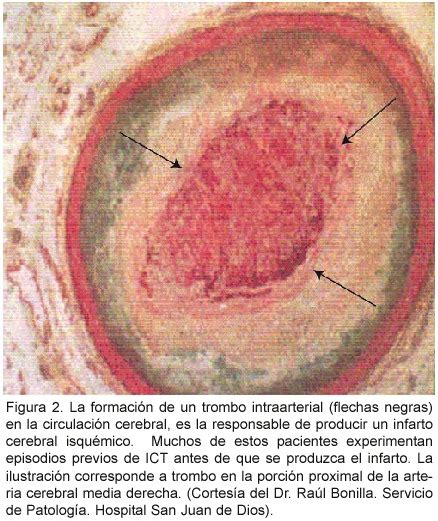 Cuando el flujo sanguíneo se recupera antes de 24 horas y no hay muerte del tejido cerebral hablamos de una isquemia cerebral transitoria. Isquemia cerebral transitoria y riesgo de infarto cerebral ...