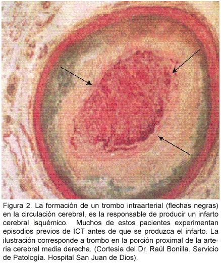 Cuando el flujo sanguíneo se recupera antes de 24 horas y no hay muerte del tejido cerebral hablamos de una isquemia cerebral transitoria. Isquemia cerebral transitoria y riesgo de infarto cerebral ...