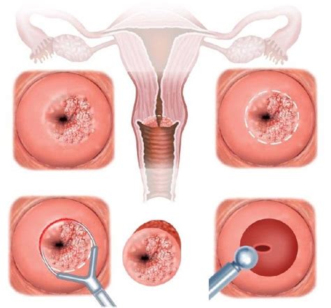 A klatskin tumor (or hilar cholangiocarcinoma) is a cholangiocarcinoma (cancer of the biliary tree) occurring at the confluence of the right and left hepatic bile ducts.the disease was named after gerald klatskin, who in 1965 described 15 cases and found some characteristics for this type of cholangiocarcinoma Cancer de col uterin - Wikipedia Cancer uterin cauze