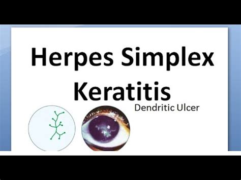 The cmgs are guidelines on the diagnosis and management of a range of common and rare, but important, eye conditions that present with varying frequency in. Ophthalmology 116 a Herpes Simplex Keratitis Virus Cornea ...