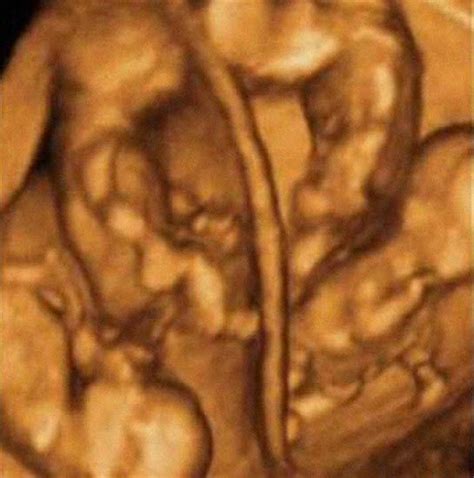 Learn a technique for ultrasound imaging of the appendix. Pin on Pro-Life