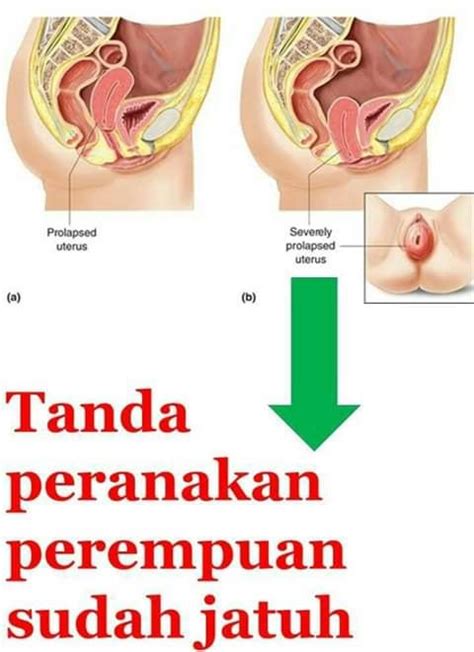 Bagaimana cara menaikkan peranakan yang turun (jatuh)? Perkhidmatan Urut Tradisional &Aura Marwaniz pantang ...