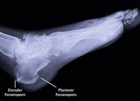 Die ferse ist im hinteren bereich über das normale maß hinaus ausgeformt, so dass zwischen fersenknochen und achillessehne ein engpass entsteht, der für. Fersensporn • Ursache, Behandlung und Übungen | Liebscher ...