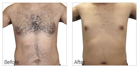 Deciding which clinic to use for your laser hair removal is a decision that shouldn't be taken lightly. Laser Hair Removal Naperville Plainfield Bolingbrook ...