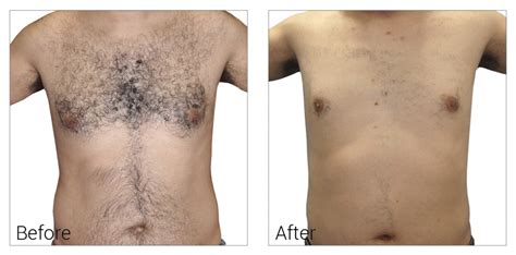 For best results, you may need at least six treatments spaced a number of weeks apart. Laser Hair Removal Naperville Plainfield Bolingbrook ...