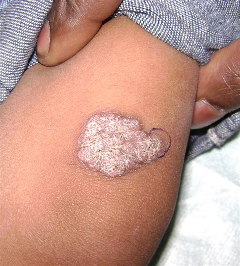 The bacteria that cause tuberculosis are spread from person to person through tiny droplets released into the air. Tuberculosis, Cutaneous - Dermatology Advisor