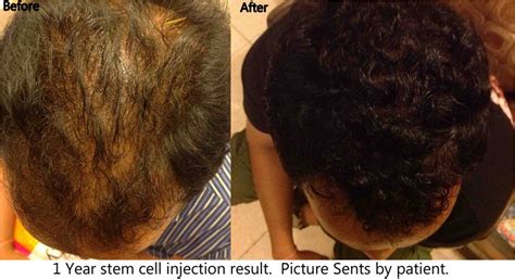 It is a type of follicular stem cell therapy against androgenetic alopecia. Hair Loss Cure Stem Cell | Hair Loss