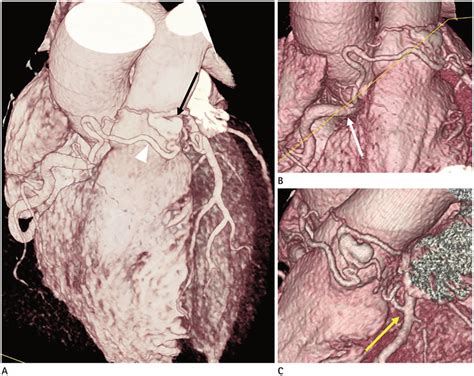 Finding diagonals in a polygon is a necessary skill to develop in math. Multi-Detector CT Coronary Angiographic Findings of Coronary-to-Pulmonary Artery Fistula