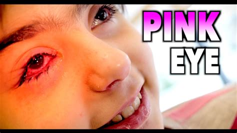 Pink eye gets its name from its bloodshot hue. WORST PINK EYE EVER? | Dr. Paul - YouTube