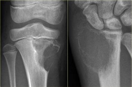 Maybe you would like to learn more about one of these? The Radiology Assistant : Bone tumor - Differential ...