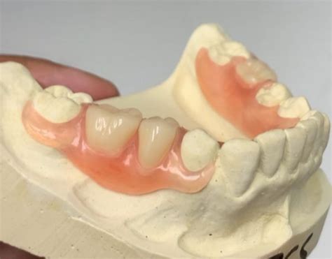 A partial denture is attached by clasps to the teeth and is easily removed by the patient. Flex Partial Dentures in Charlotte | Build-A-Smile