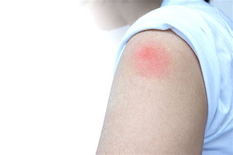 It is mandatory for vaccination providers to report to the vaccine adverse event hypersensitivity events in the vaccine group included injection site rash and injection site urticaria. Fever, Aches From Pfizer, Moderna Jabs Aren't Dangerous ...