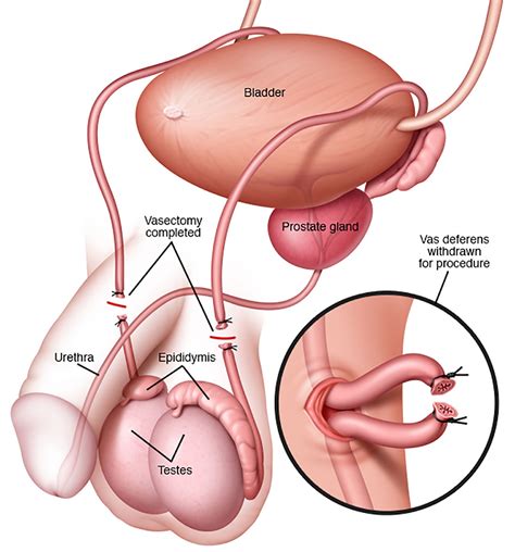 How do i get a vasectomy? Tubal Ligation - Pregnancy After Tubal Ligation, Side Effects