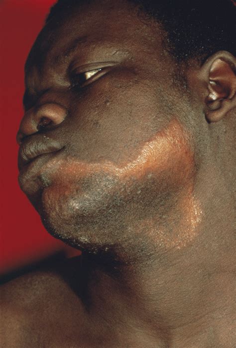 This term was formerly given to various skin diseases, the leprosy of modern authors being lepra arabum. Lepra - Infektionskrankheiten - MSD Manual Profi-Ausgabe