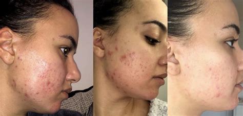 How long is the purge? 6 Months Tretinoin 0.05 % use... The 1st picture is ...