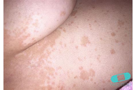 Tinea versicolor is a condition characterized by a skin eruption on the trunk and proximal extremities. Hudläkare på nätet - Pityriasis versicolor (tinea verisicolor)