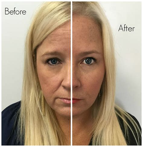 , you can typically expect to see and feel the full effects of botox 10 to 14 days after the procedure. How to Get Rid of Wrinkles in 10 Days | Glam Karen ...