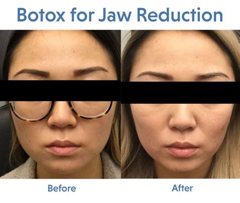 How long does botox last? How Fast Does Botox Work - Photos Idea