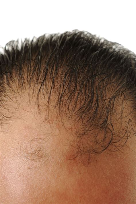 Foreskin May Help Cure Male-Pattern Baldness -- The Cut