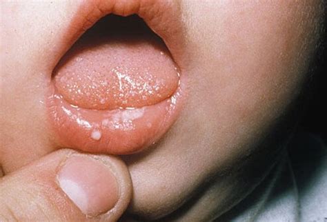 About 70 percent of all adults in the u.s. Picture Of Baby Yeast Infections Picture Image on RxList.com
