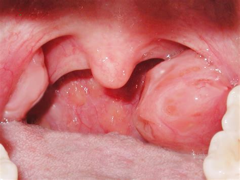 Tonsillitis is treated with antibiotics; One Tonsil Larger than the Other a Sign of Cancer ...