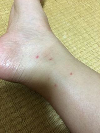 ダニ？蚊？？ - 足首だけ赤いプツプツができて痒いです ...