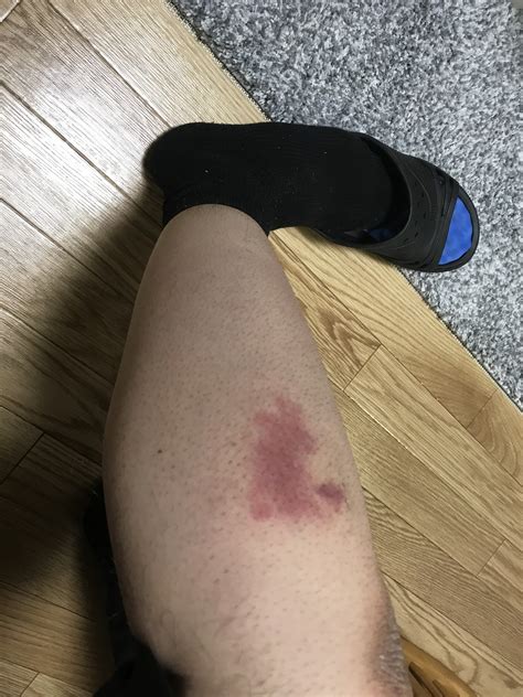蜂に刺されてしまったら？？ 便利屋七道の蜂駆除サービス ...