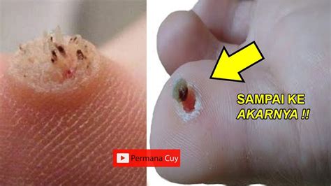 1) penyakit kulit seperti jerawat yang berinti keras di bagian atas jari kaki, sering juga pada telapak kaki dan tumit; Cara Ampuh Menghilangkan Mata Ikan Sampai Ke akarnya - YouTube