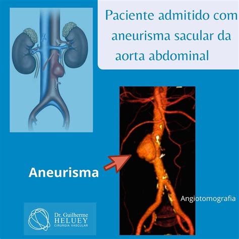 Diagnosticar um aneurisma da aorta abdominal. Pin em Aneurisma