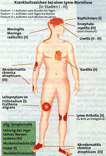 Borreliose der verlauf plus symptome. Borreliose